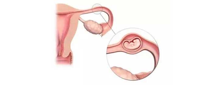生化妊娠-双侧输卵管妊娠