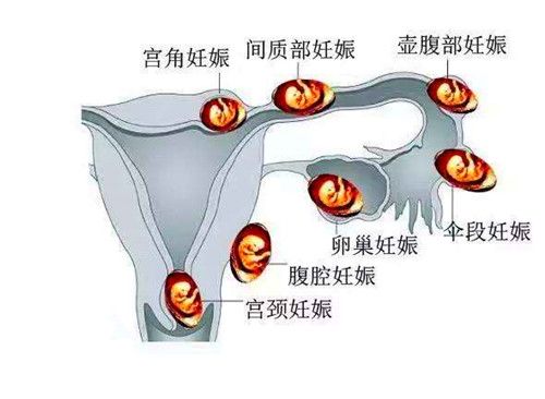 宫外孕妊娠分布