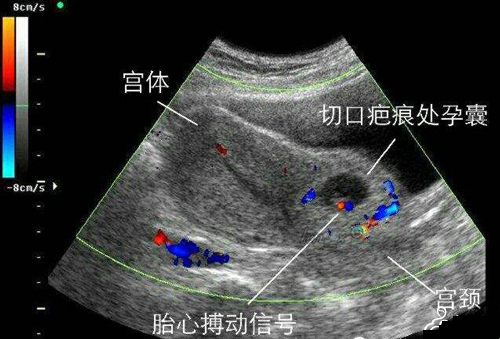 超声诊断疤痕子宫切口妊娠