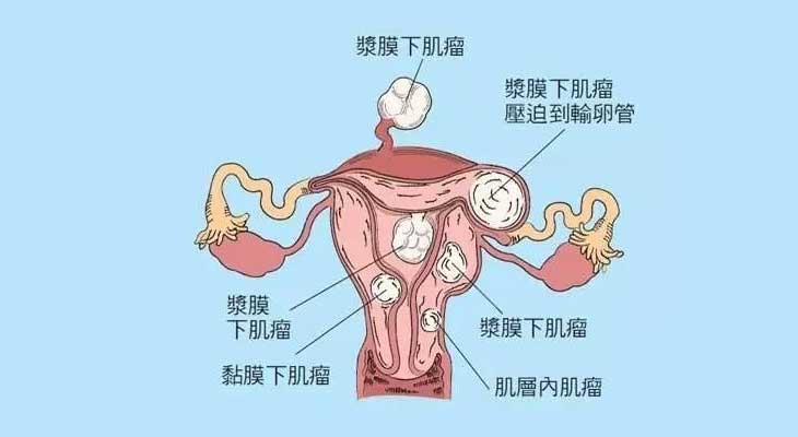 子宫子宫肌瘤的临床诊断